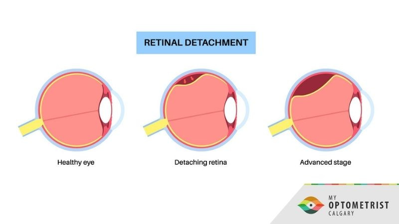 5 Warning Signs of Retinal Detachment That Should Never Be Ignored